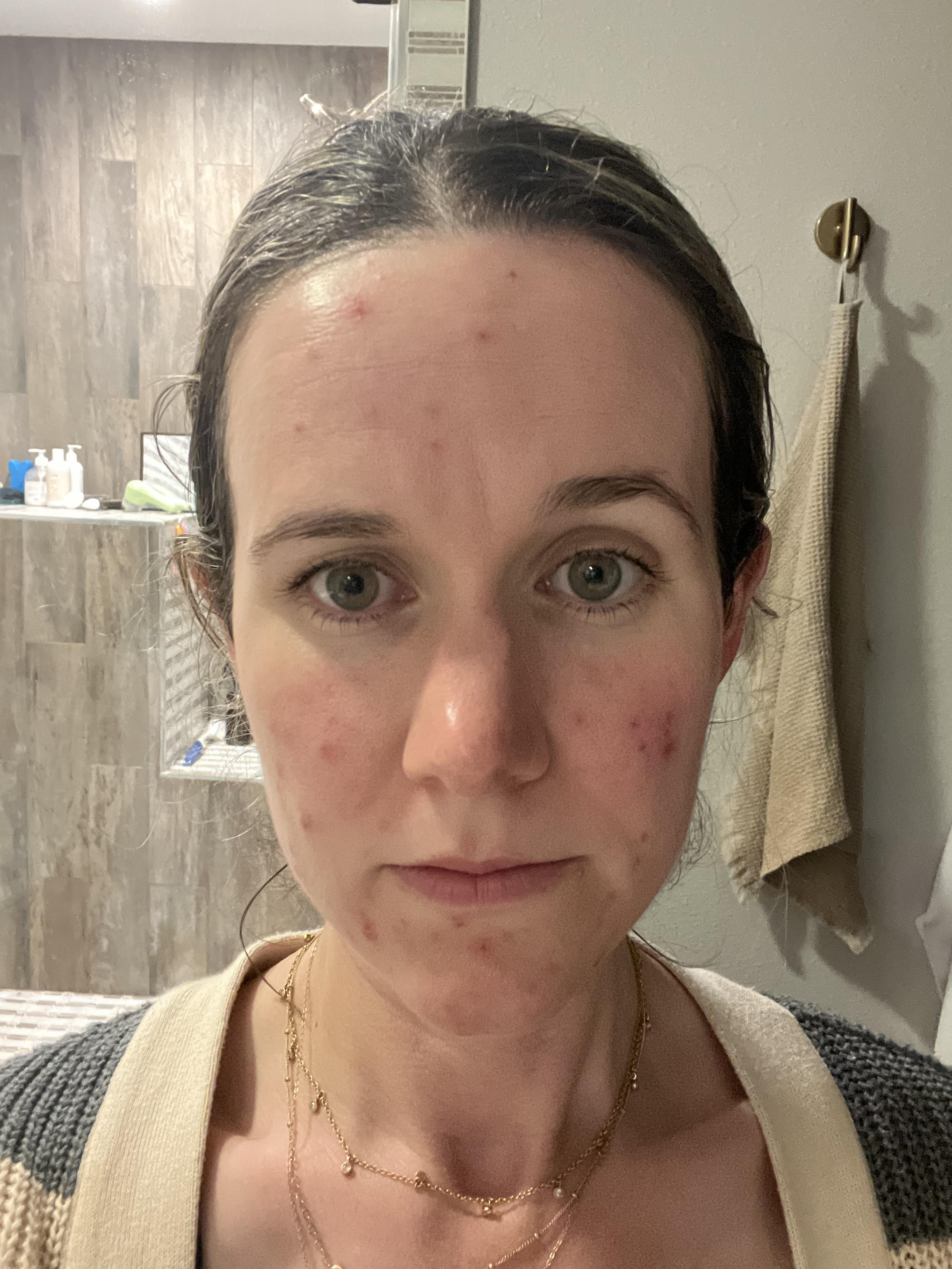 Before clearing hormonal acne